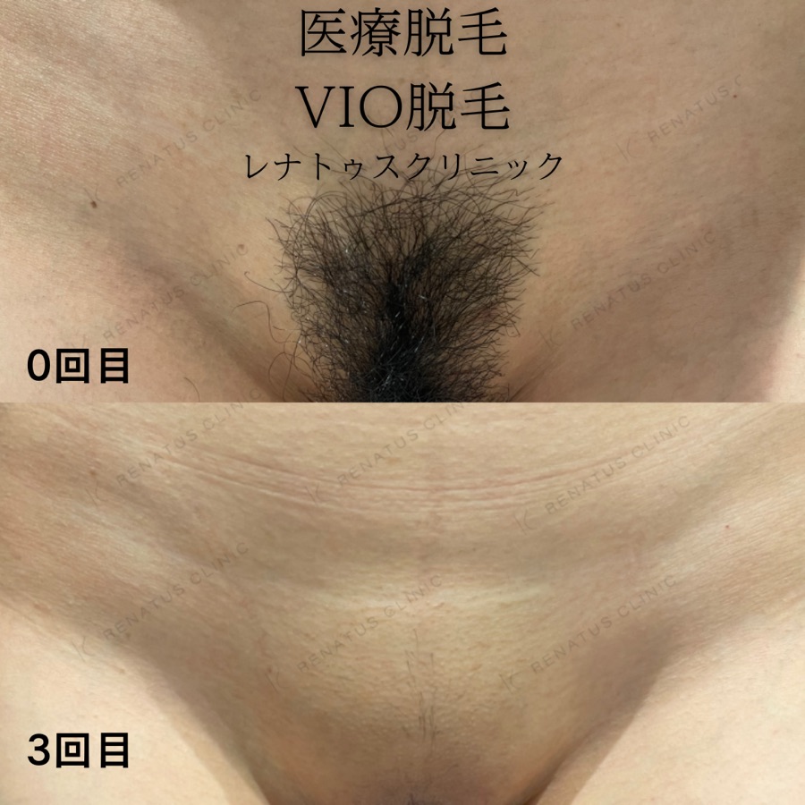 VIO・顔脱毛 症例写真