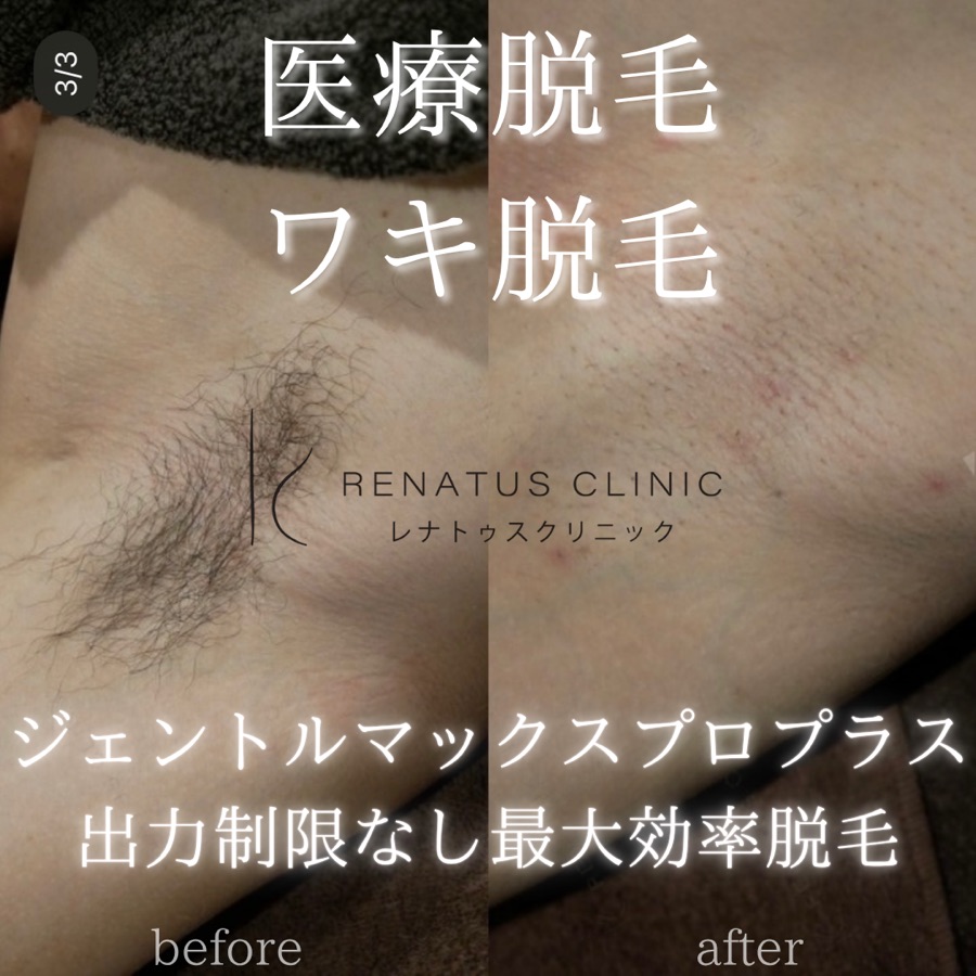脱毛症例写真（参考）